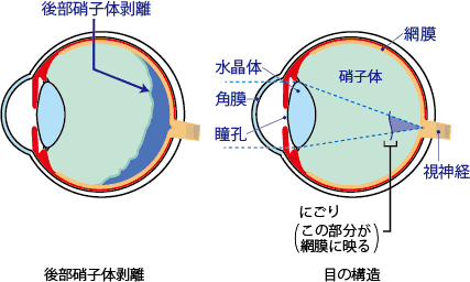 剥離 後部 硝子 体