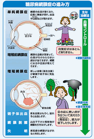 糖尿病網膜症の治療を足立区でお探しなら千住町眼科まで|土日診療