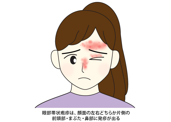 帯状疱疹